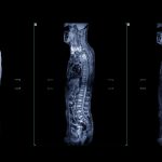 De ce este esențial să investighezi complet coloana vertebrală cu ajutorul unui RMN avansat