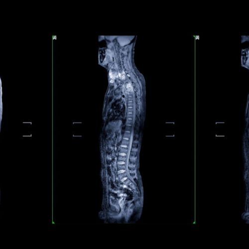 De ce este esențial să investighezi complet coloana vertebrală cu ajutorul unui RMN avansat