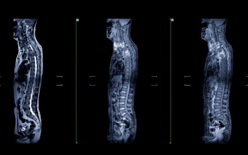 De ce este esențial să investighezi complet coloana vertebrală cu ajutorul unui RMN avansat