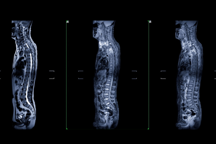 De ce este esențial să investighezi complet coloana vertebrală cu ajutorul unui RMN avansat