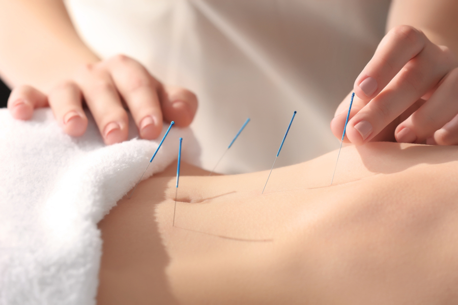 Beneficiile acupuncturii în combaterea infertilității