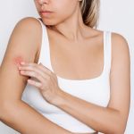 psoriazis shutterstock_2362485103